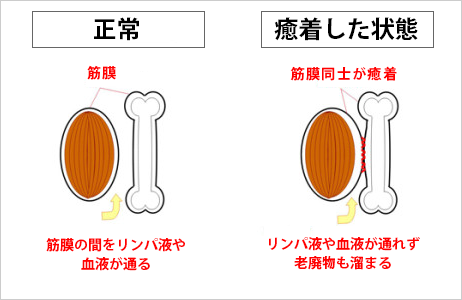 筋膜リリースとは？